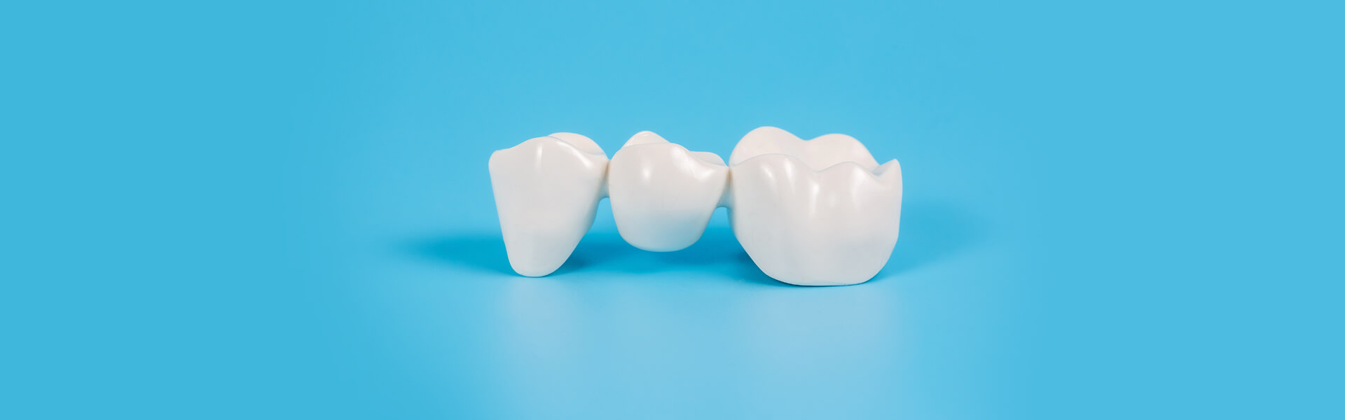 All You Need to Know About Dental Bridges Procedure